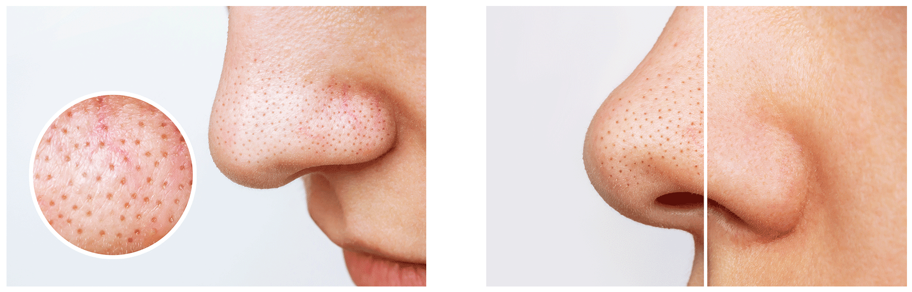 毛穴洗浄ローションZENHAREN